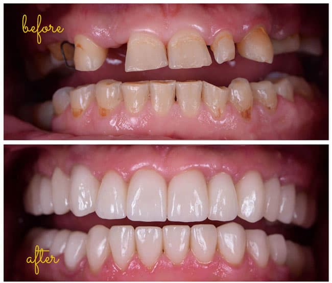 types of dental implant restorations